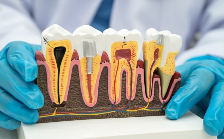 Signs Your Toothache Could Mean You Need a Root Canal