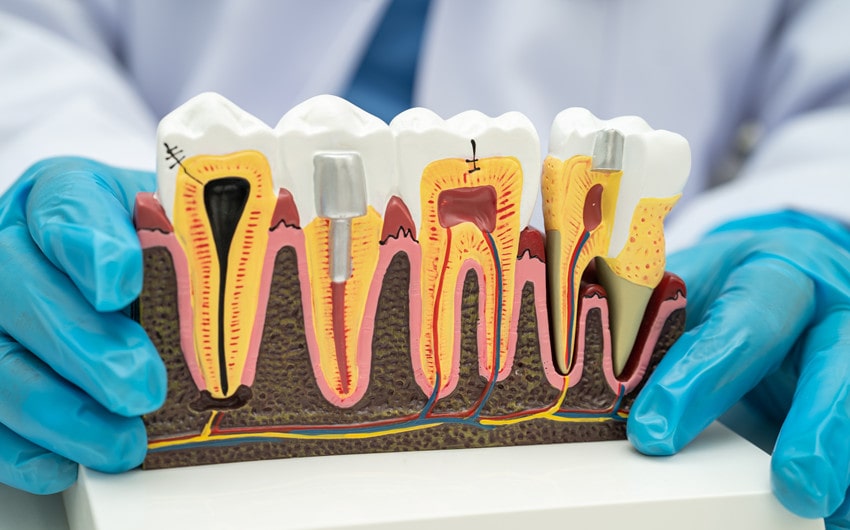 toothache need a root canal